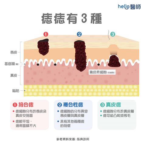 墨痣形成